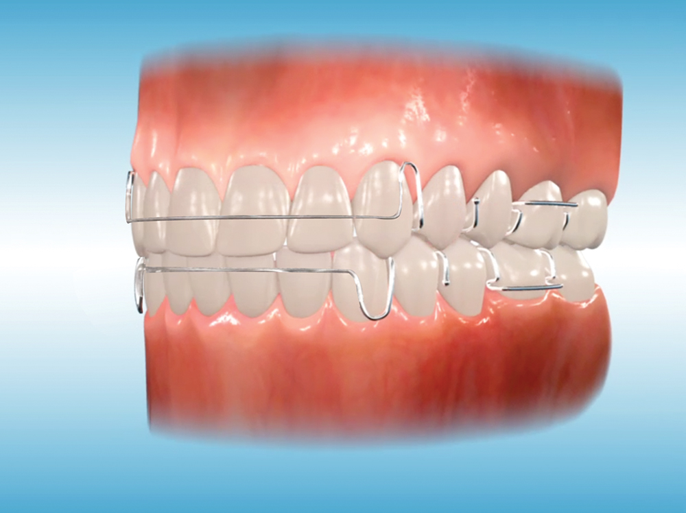 Ortho. Ретейнеры ортодонтические. Несъемный ортодонтический ретейнер. Ретейнер Американ Ортодонтикс.