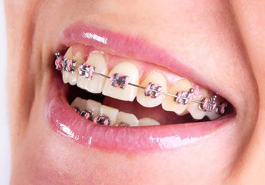 silver braces bands