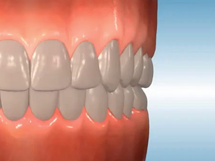 Orthodontic Terms - Types of Teeth & Locations in the Mouth