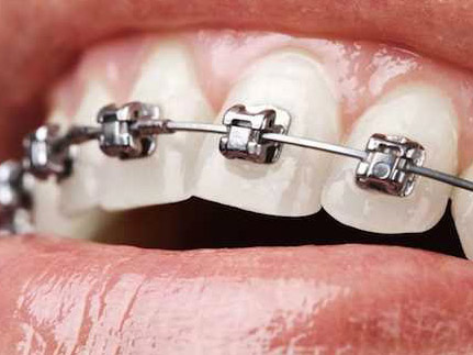 Orthodontic Terms - Orthodontic Procedures